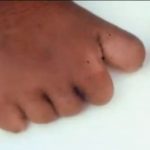 Reincarnation-birthmark-2